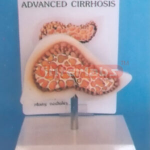 DESK-TYPE, ADVANCED CIRRHOSIS MODEL WITH DESCRIPTION PLATE