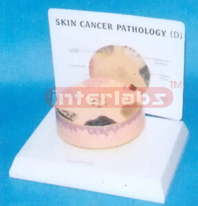 HUMAN SKIN CANCER MODEL WITH DESCRIPTION PLATE