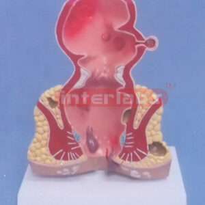 DESKTYPE COMMOM PATHOLOGIES MODEL OF RECTUM