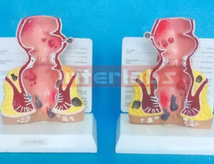 DESKTYPE,COMMOM PATHOLOGIES MODEL OF RECTUM WITH DECSRIPTION PLATE