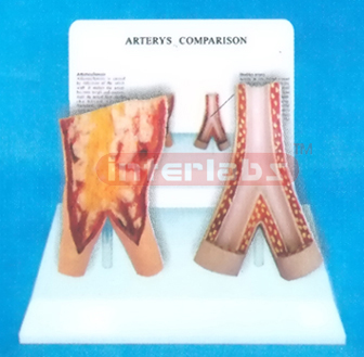 DESK-TYPE, ARTERY MODEL FOR COMPARISION DEMONSTRATING HEALTHMAN THAN SMOKING MAN WITH DESCRIPTION PLATE