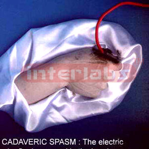 Cadaveric spasm in a case of electrocution