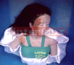Abrasion on the face