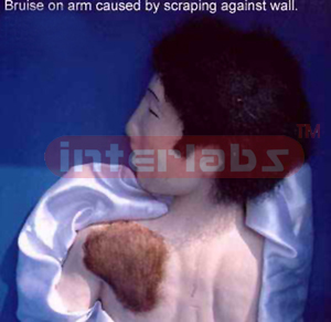 Bruise on shoulders caused by scraping against a wall