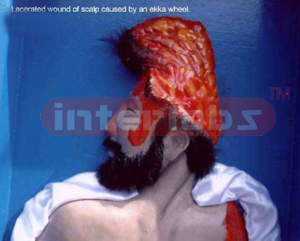 Lacerated wound of scalp caused by an Ekka wheel