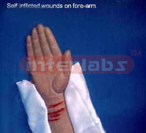 Self inflicted wound on forearm