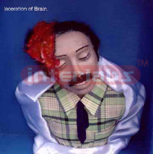 Laceration of Brain