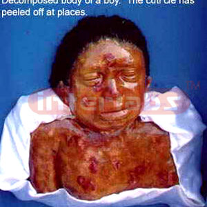 Decomposed body of a boy showing peeled cuticle