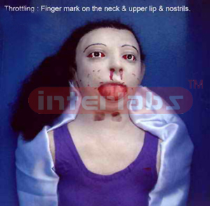 Throttling - Finger marks on neck, upper lip and nostrils