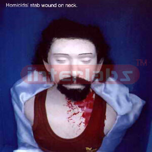 Homicidal stab wound on neck