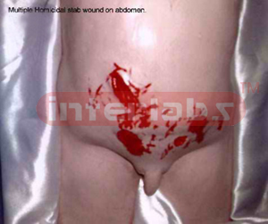 Multiple homicidal stab wounds on abdomen