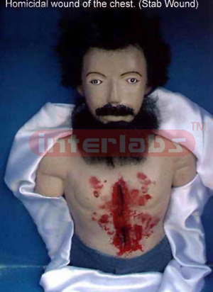Homicidal stab wound of the chest