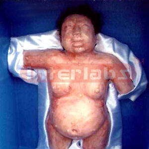 Decomposed body of a male showing blisters