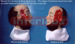 Wound of a revolver bullet in skull bones