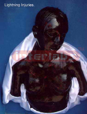 Lightning injuries
